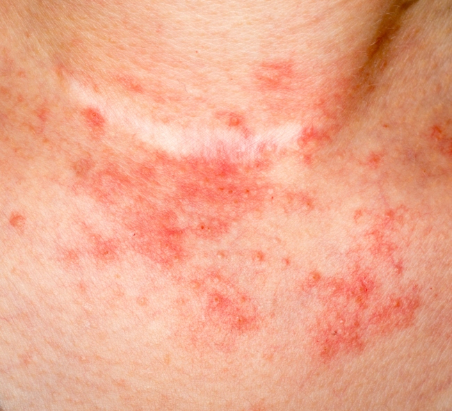 Bőrbetegségek enyhítése gyógygombákkal